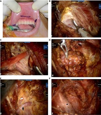 Feasibility of transoral robotic selective neck dissection with or without a postauricular incision for papillary thyroid carcinoma: A pilot study